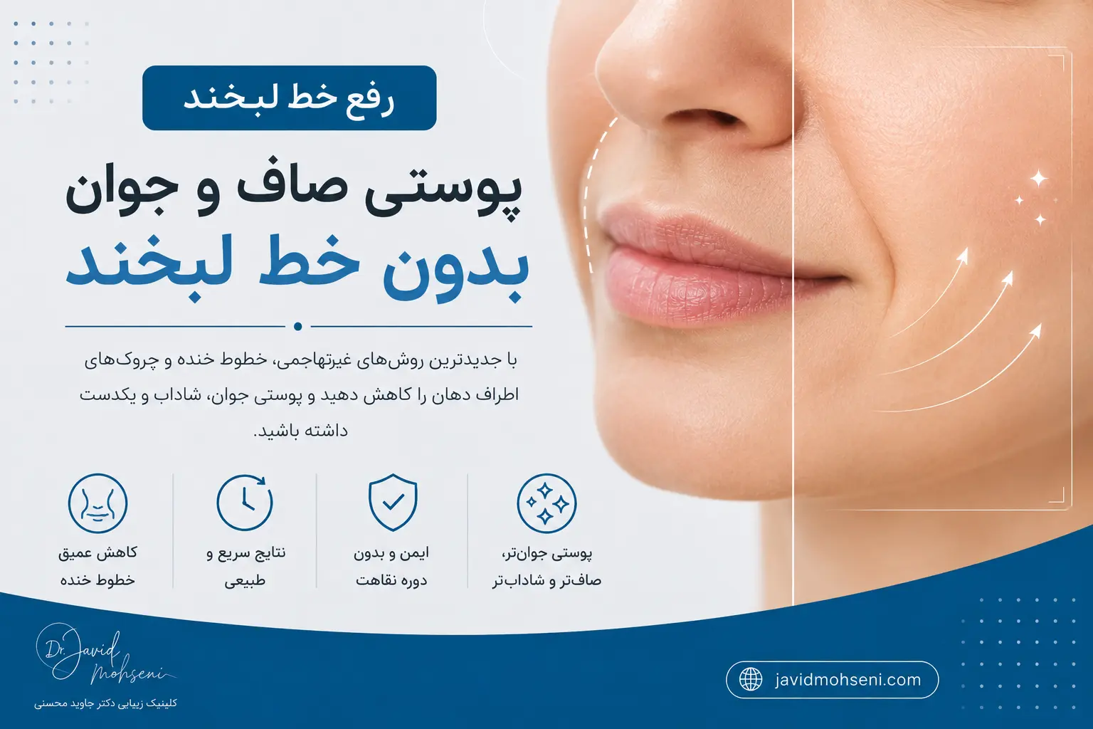 رفع خط لبخند | بهترین روش‌ها، ماندگاری و مراقبت‌های بعد از درمان