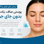درمان جای جوش و آکنه