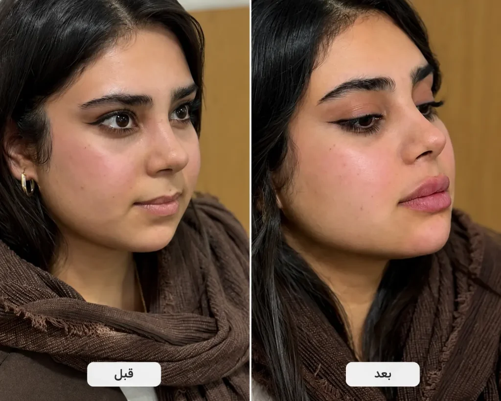تزریق فیلر چانه