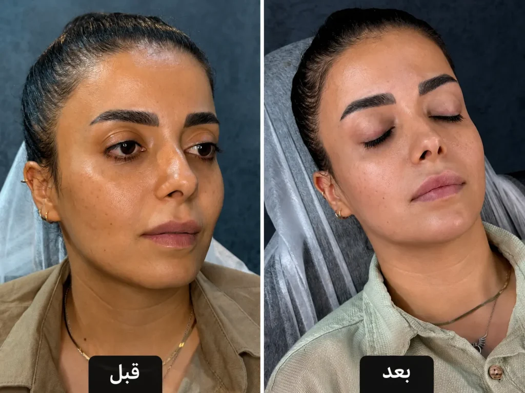 تزریق فیلر چانه