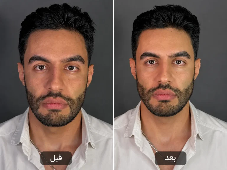 فیلر زاویه فک