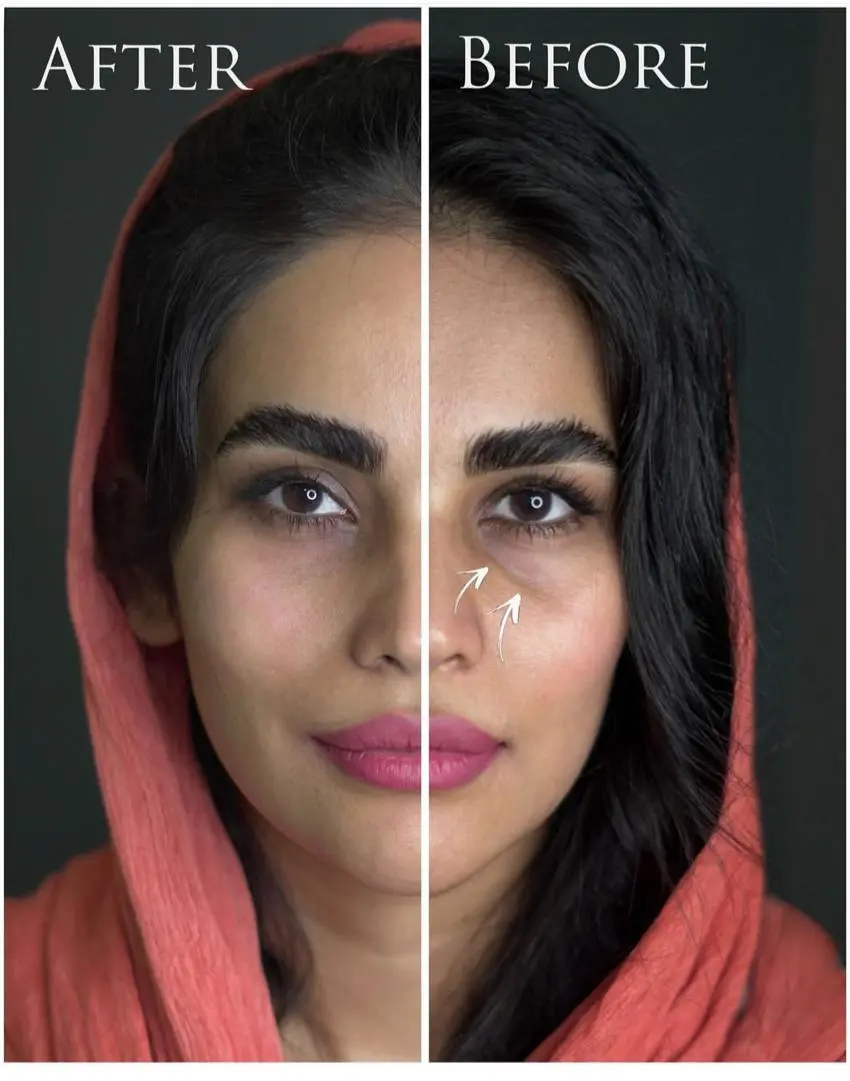 تزریق فیلر زیر چشم