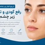 فیلر زیر چشم