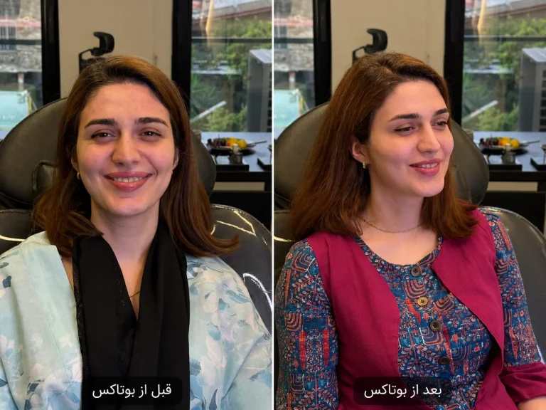 تزریق بوتاکس