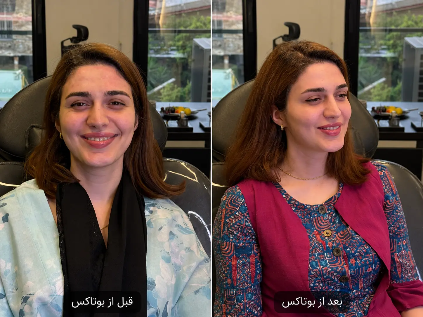 بوتاکس صورت – رفع چین و چروک